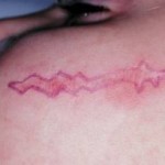 Geometric Facial Scar Revision Dr Barry Eppley Indianapolis