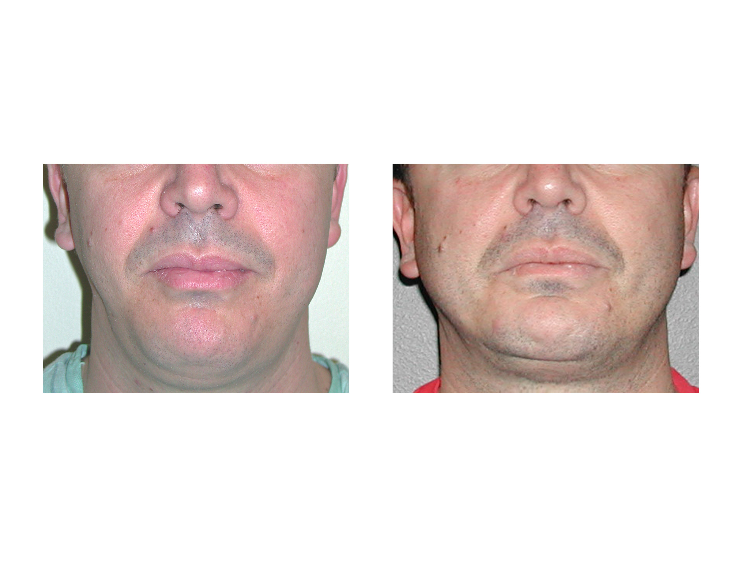 Tear Trough Implants