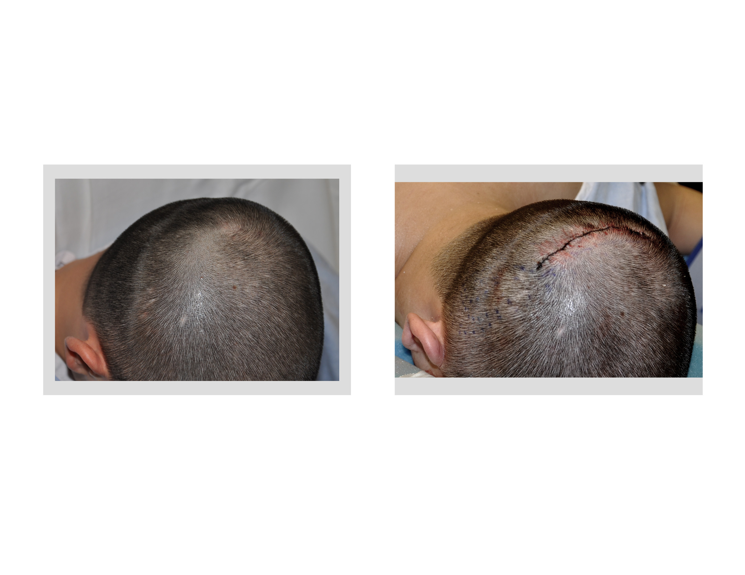  - Small-Incision-Occipital-Cranioplasty-right-oblique-view-Dr-Barry-Eppley-Indianapolis