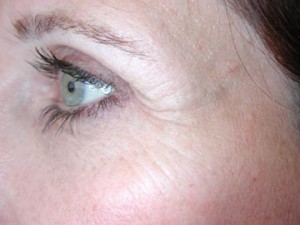Botox Crow's Feet Dr Barry Eppley Indianapolis