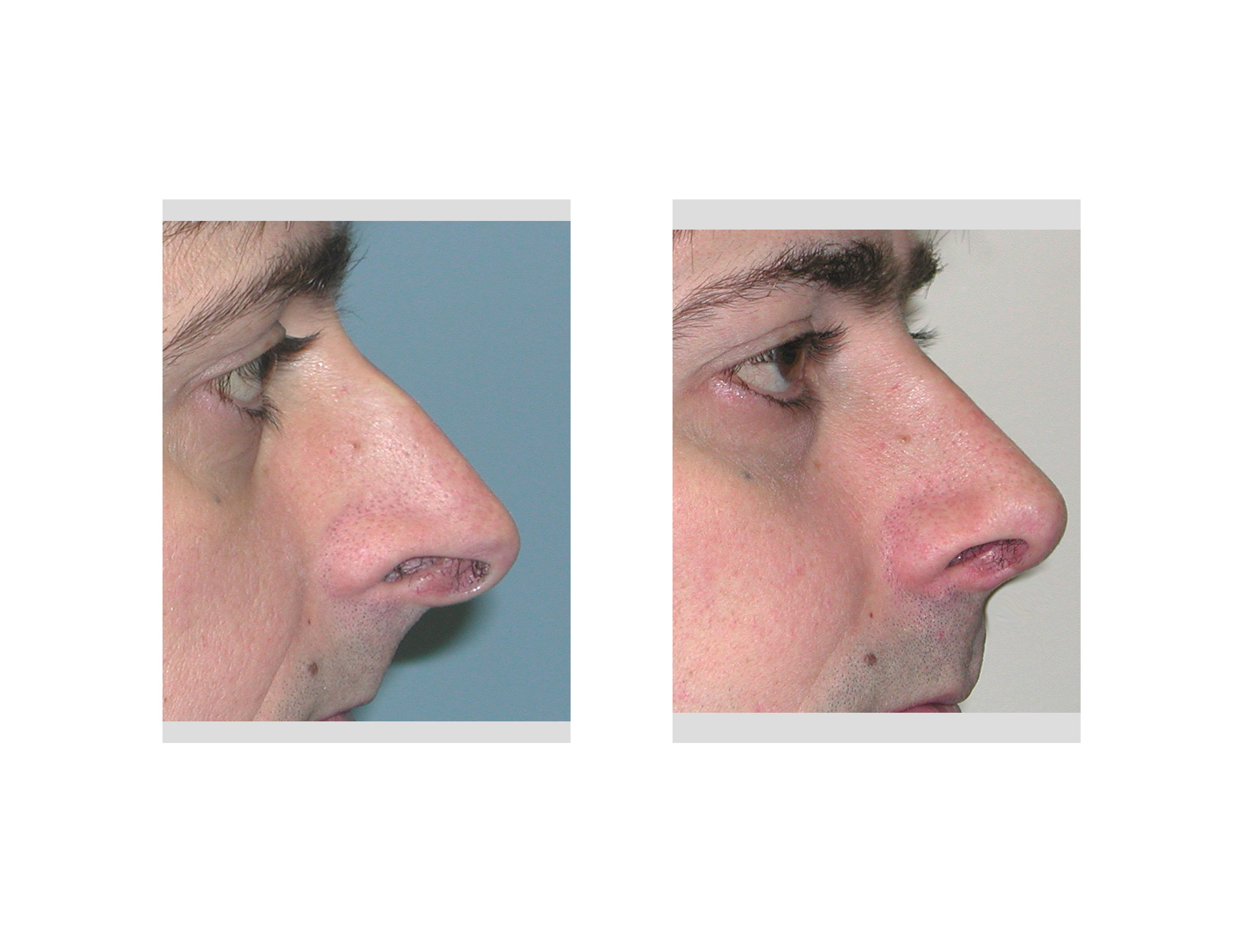  - Overprojecting-Nose-Rhinoplasty-Dr-Barry-Eppley-Indianapolis
