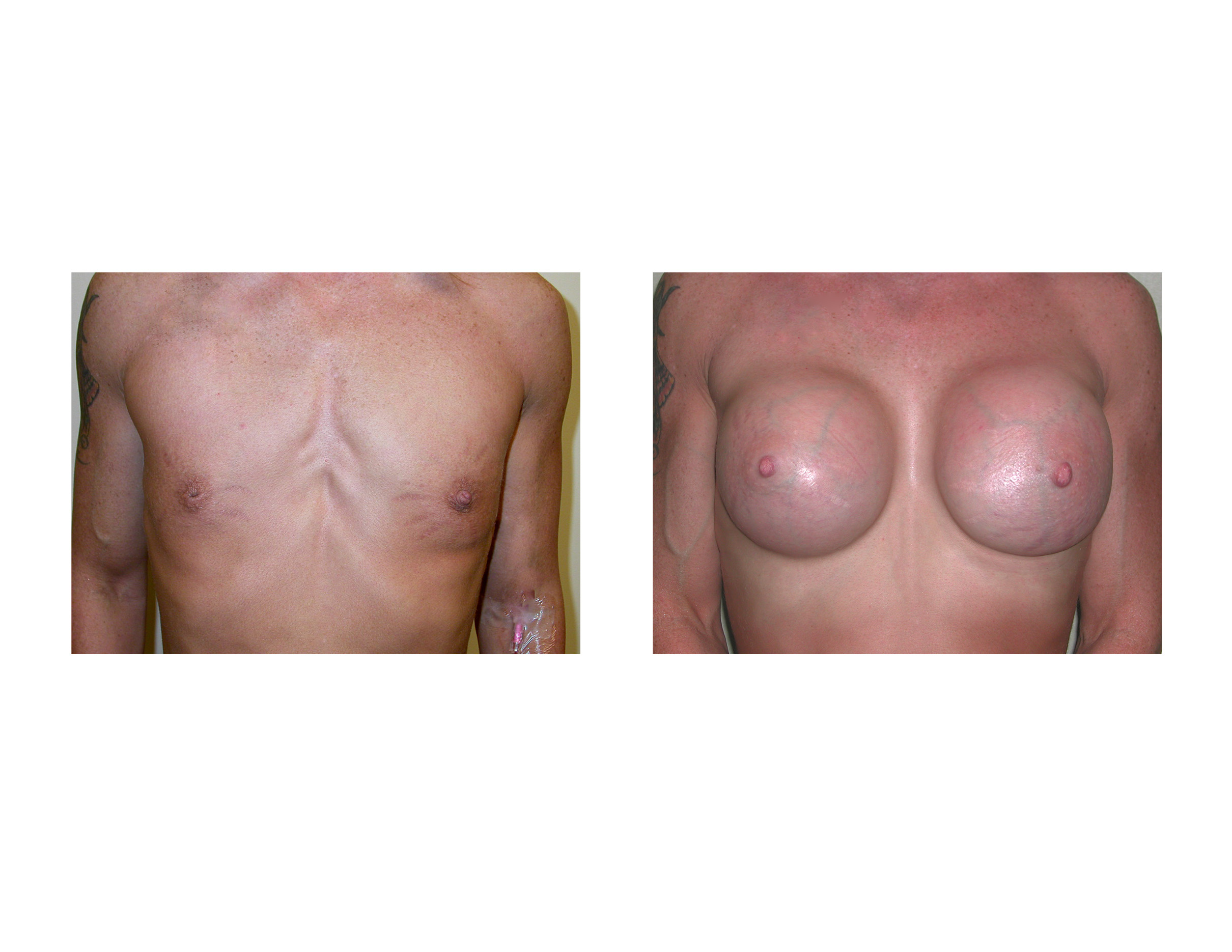 Body Builerds Breasts 3