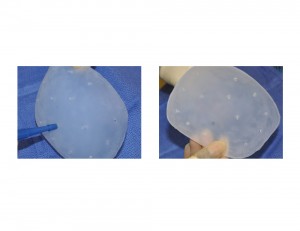 Custom Occipital Implant Perforations Dr Barry Eppley Indianapolis