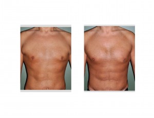 Pectoral Implants after Weight Loss result front view Dr Barry Eppley Indianapolis