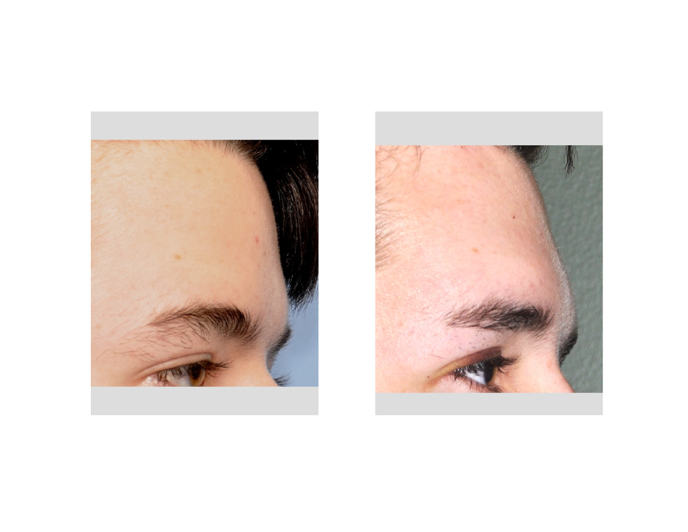 brow bone augmentation Archives
