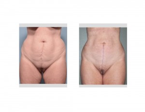 Vertical Tummy Tuck results front view Dr Barry Eppley Indianapolis