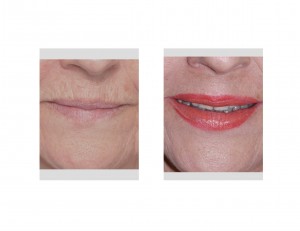 Upper Lip Chin Laser Resurfacing Dr Barry Eppley Indianapolis
