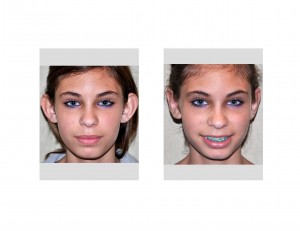 Conchal Otoplasty Dr Barry Eppley Indianapolis