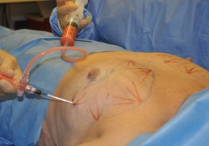 Fat Injection Breast Augmentation Indianapolis Dr Barry Eppley