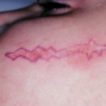 Geometric Facial Scar Revision Indianapolis Dr Barry Eppley