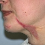 Scar Revision Indianapolis Dr Barry Eppley