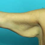 arm-lift-brachioplasty-indianapolis-dr-barry-eppley