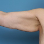 arm-lift-elbow-lift-indianapolis-dr-barry-eppley1