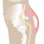 buttock-implants-indianapolis-dr-barry-eppley