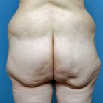buttock-lift-indianapolis-dr-barry-eppley