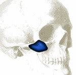 cheek-implants-dr-barry-eppley-indianapolis
