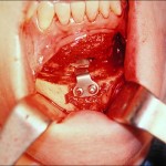 chin-osteotomy-indianapolis-dr-barry-eppley
