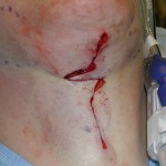 direct-neck-lift-dr-barry-eppley-indianapolis
