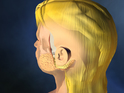 facelift-video-dr-barry-eppley-indianapolis
