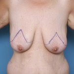 full-breast-lifts-indianapolis-dr-barry-eppley