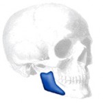 jaw-angle-implants-indianapolis-dr-barry-eppley3