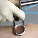 laser-hair-removal-indianapolis-dr-barry-eppley