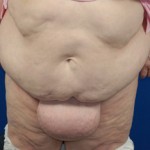 pubic-lift-monsplasty-indianapolis-dr-barry-eppley