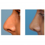 rhinoplasty-ethnic-indianapolis-dr-barry-eppley