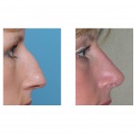 rhinoplasty-indianapolis-dr-barry-eppley