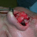 rhinoplasty-open-indianapolis-dr-barry-eppley
