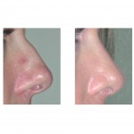 rhinoplasty-surgery-indianapolis-dr-barry-eppley