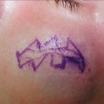 scar-revision-geometric-excision-indianapolis-dr-barry-eppley