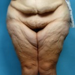 thigh-lifts-indianapolis-dr-barry-eppley