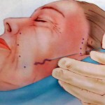 threadlift-facelift-indianapolis-dr-barry-eppley