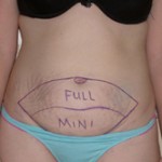 tummy-tucks-full-vs-mini-indianapolis-dr-barry-eppley