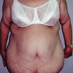 abdominal-panniculectomy-indianapolis-dr-barry-eppley