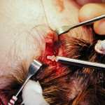 lactosorb-endoscopic-browlift-dr-barry-eppley-indianapolis