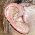 limited-facelift-lifestyle-lift-incision-dr-barry-eppley-indianapolis