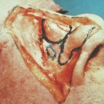 rhinoplasty-surgeon-dr-barry-eppley-indianapolis1