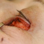 blepharoplasty-hernia-repair-of-lower-eyelid-bags-dr-barry-eppley-indianapolis