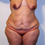 body-contouring-after-massive-weight-loss-dr-barry-eppley-indianapolis6