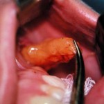 buccal-lipectomy-buccal-fad-pad-removal-indianapolis-dr-barry-eppley