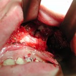 cheek-bone-zygomatic-fracture-repair-with-lactosorb-dr-barry-eppley-indianapolis