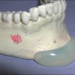 chin-implant-central-button-indianapolis-dr-barry-eppley