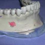 chin-implant-extended-indianapolis-dr-barry-eppley