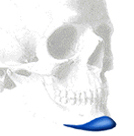 chin-implant-surgery-indianapolis-dr-barry-eppley