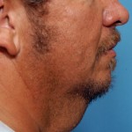 facelift-after-massive-weight-loss1