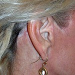 facelift-incisions-and-scars-indianapolis-dr-barry-eppley