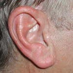 male-facelift-scar-dr-barry-eppley-indianapolis