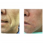 nasolabial-fold-release-surgiwire-dr-barry-eppley-indianapolis